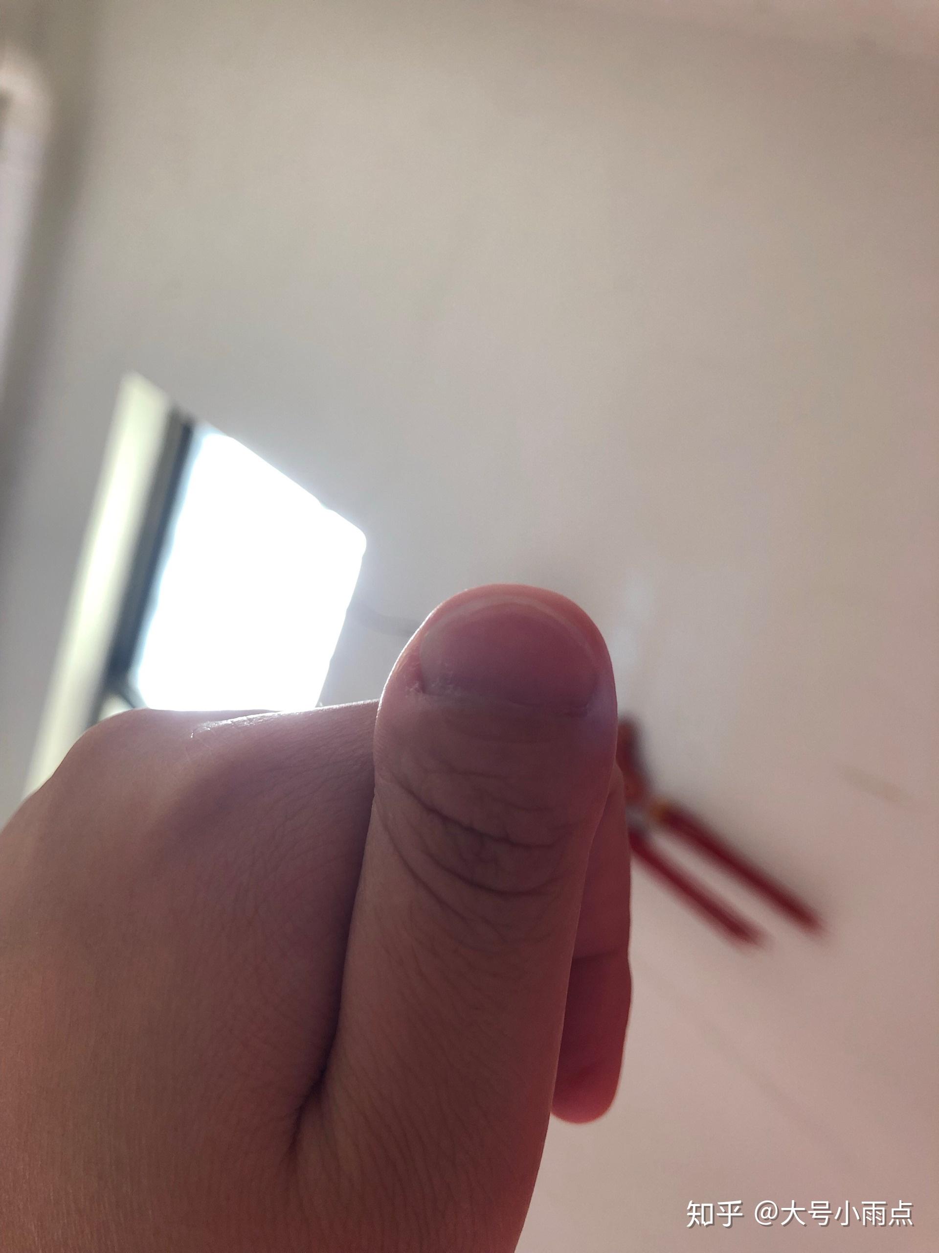 为什么我的大拇指又宽又短