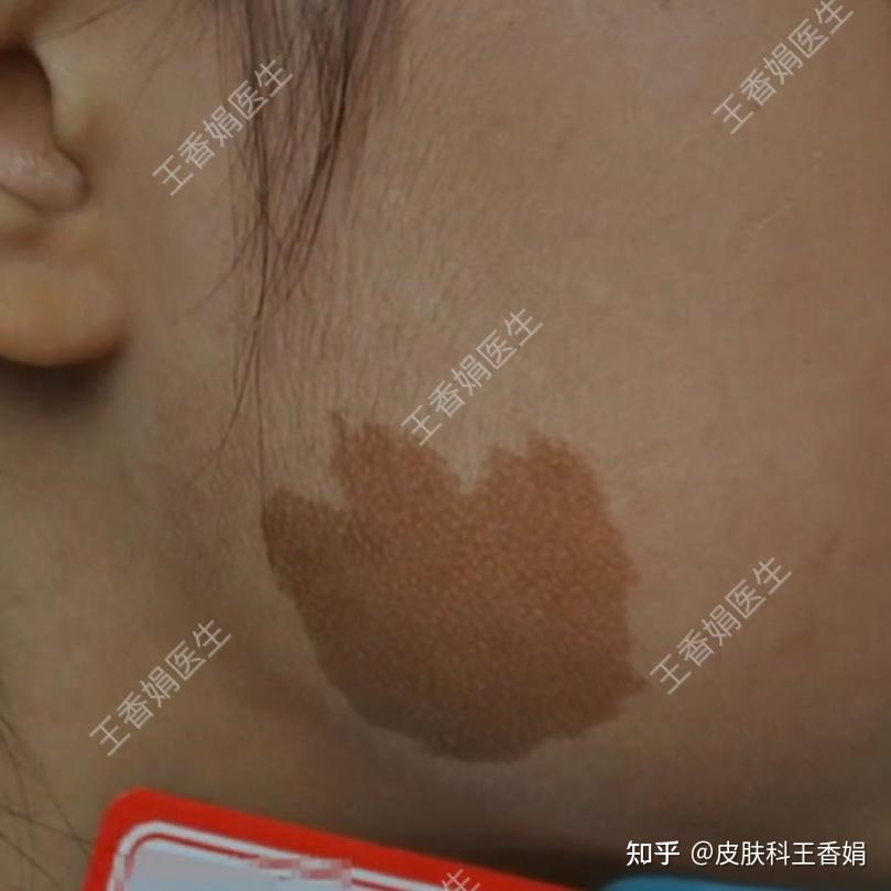 牛奶咖啡斑目前有治愈的案例吗