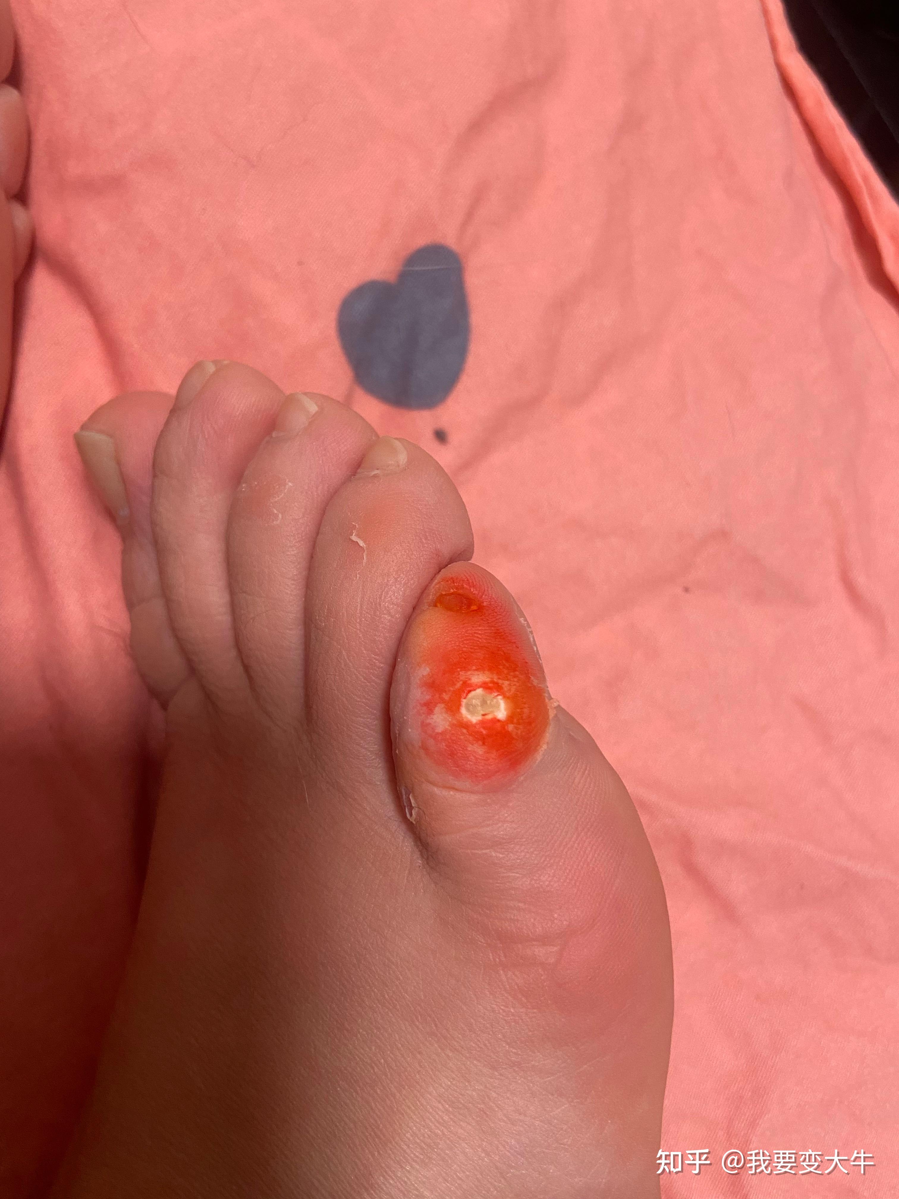 我的脚小拇指的外侧有个小茧子好疼按压疼不能穿漂亮的高跟鞋这是怎么