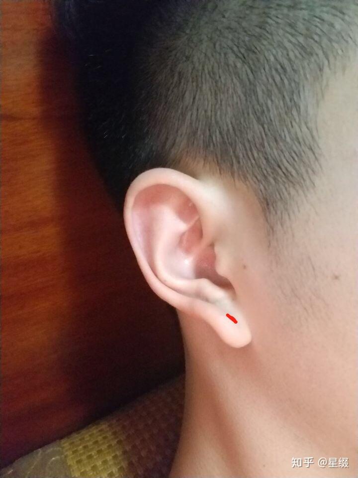 内卷耳垂怎么打耳洞呢