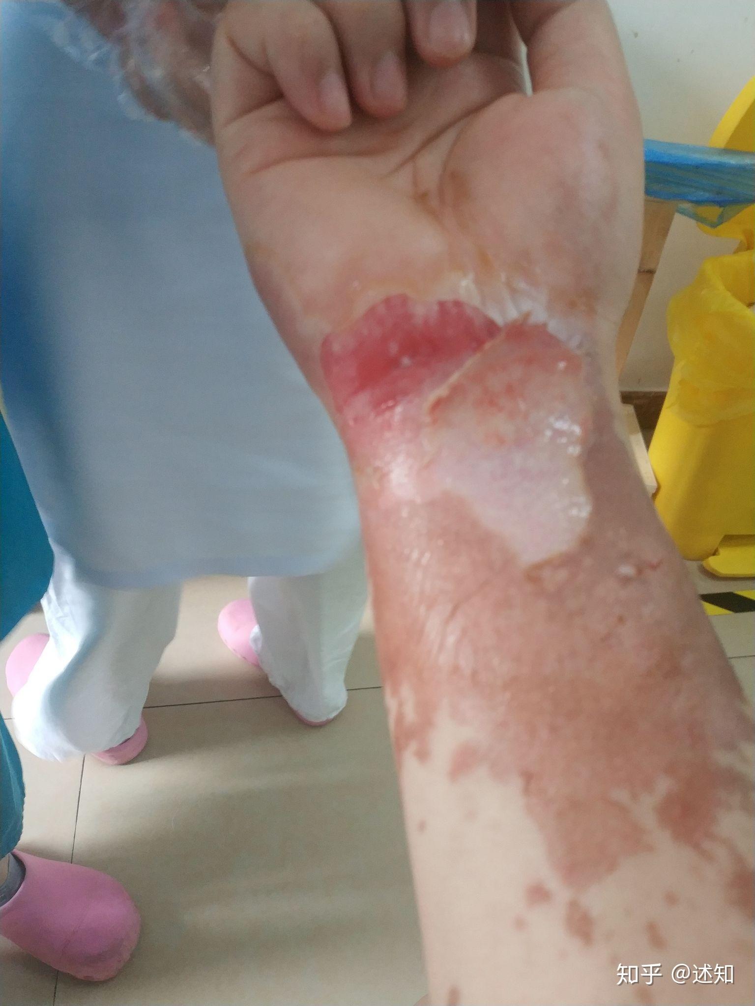 被油烫伤了怎么处理