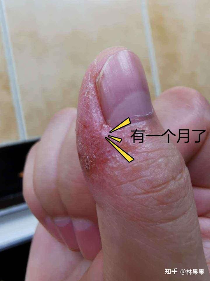 手上长小水泡怎么回事