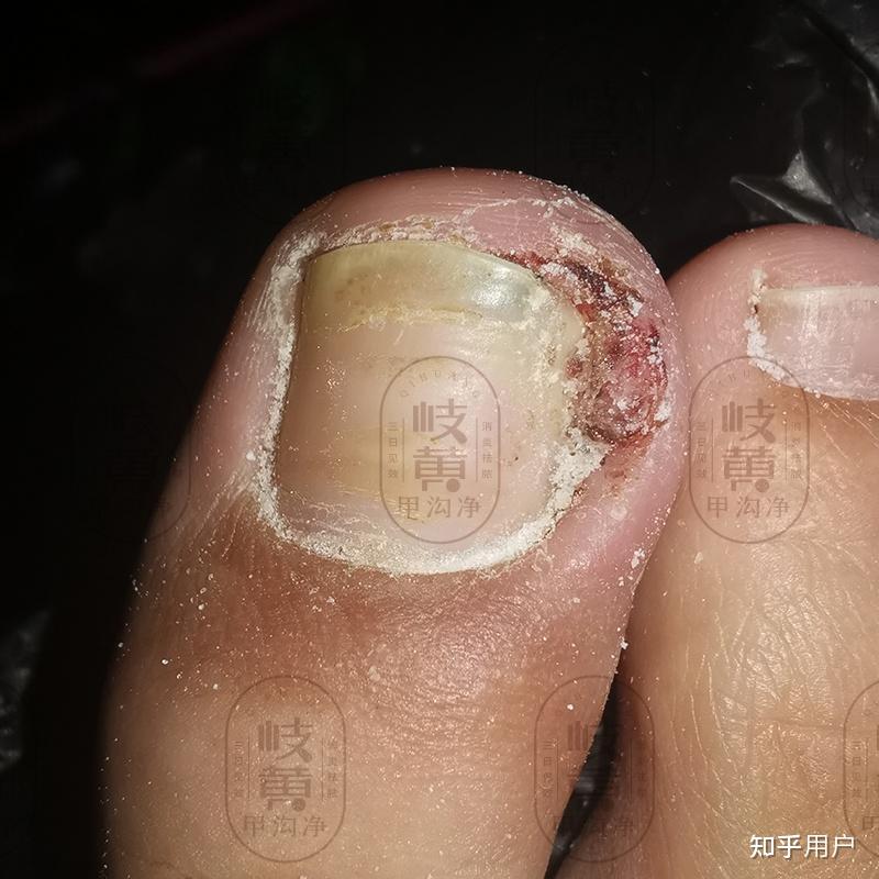 甲沟炎化脓了,怎么在家处理? - 知乎