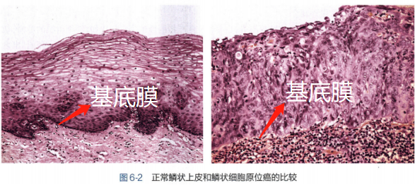 所以说，原位癌到底是不是癌？ - 知乎