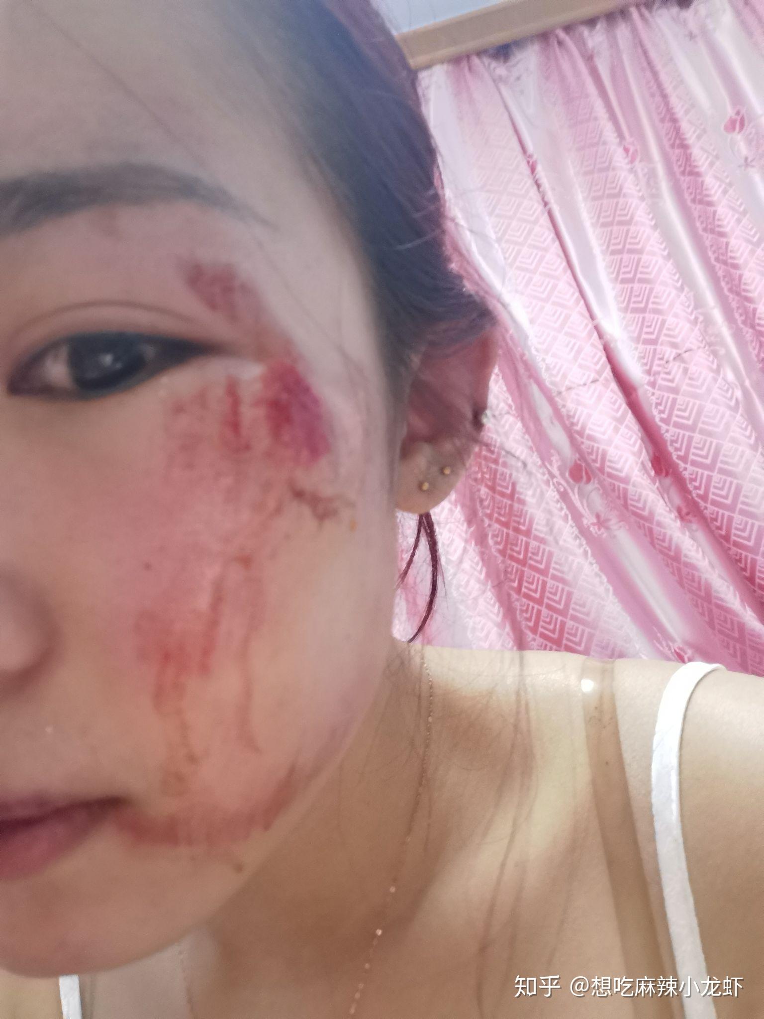 脸摔破了怎么才能不留疤