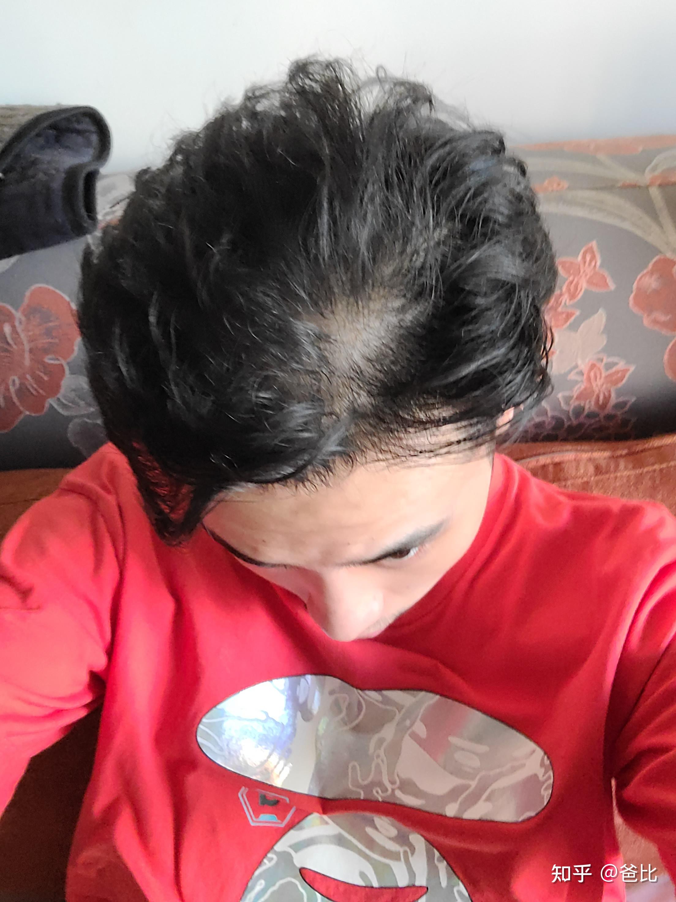 19岁就快秃顶了人生是不是完了? - 知乎