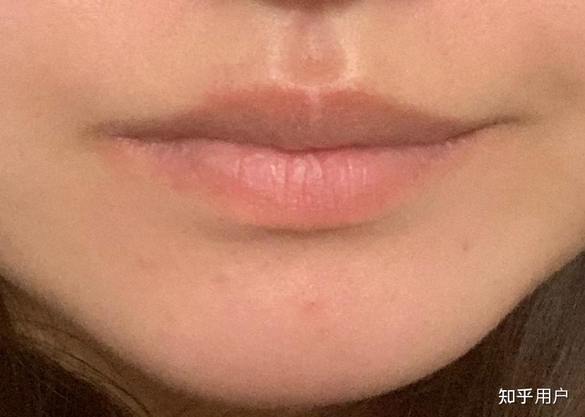 嘴唇不对称怎么办