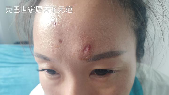克巴世家|过了二十多年，决定修复脑门上的凹陷疤痕 - 知乎