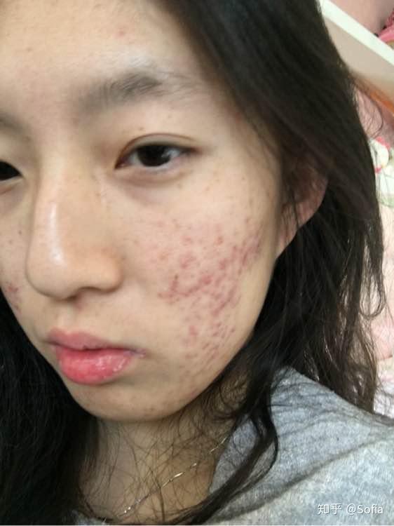 求助挤出来的痘痘全是血还有些许黄白脓状物不是用力挤轻轻一挤就是血