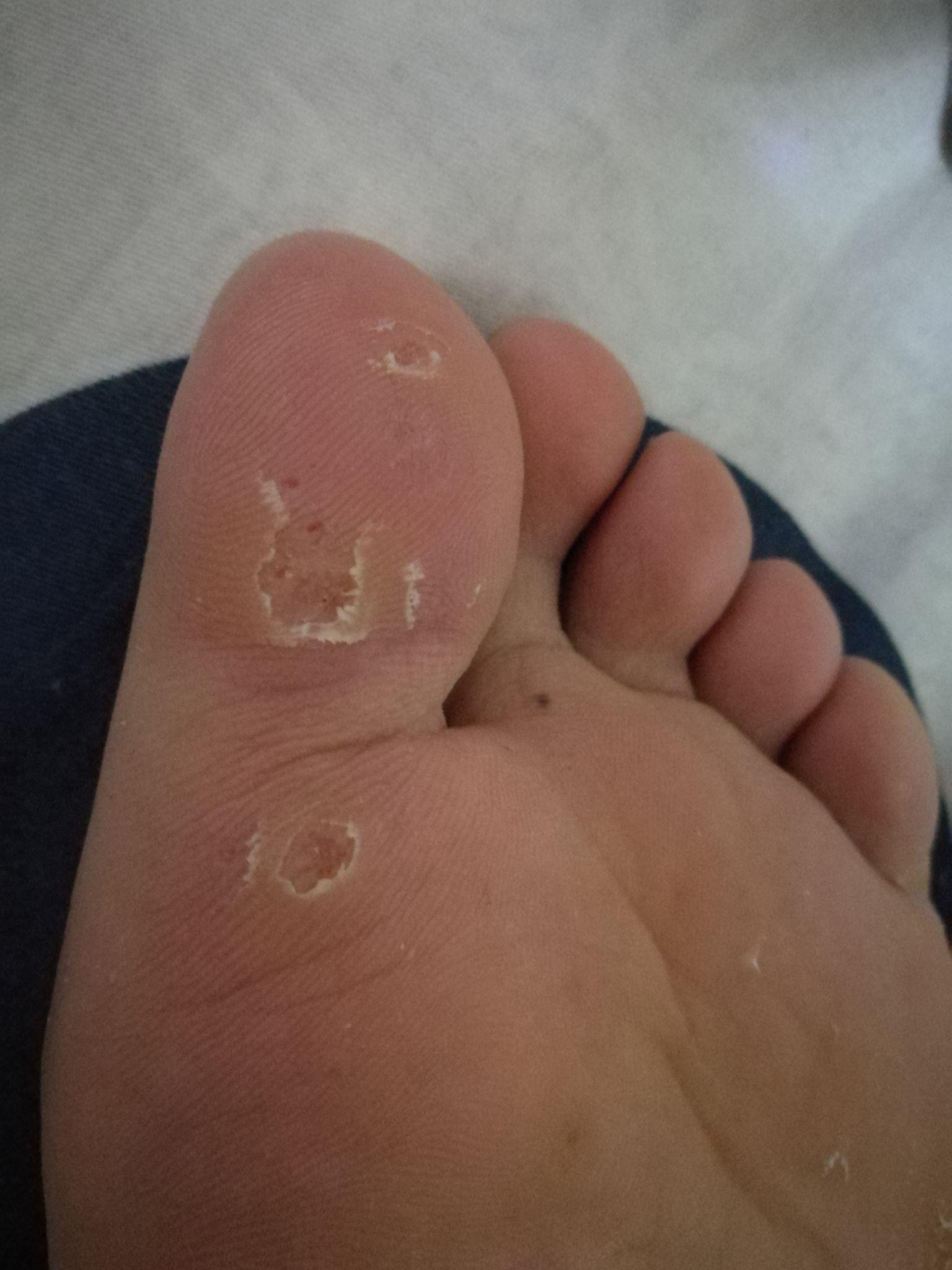 跖疣冷冻完结痂脱落后这样是痊愈了吗按着不硬也不疼了