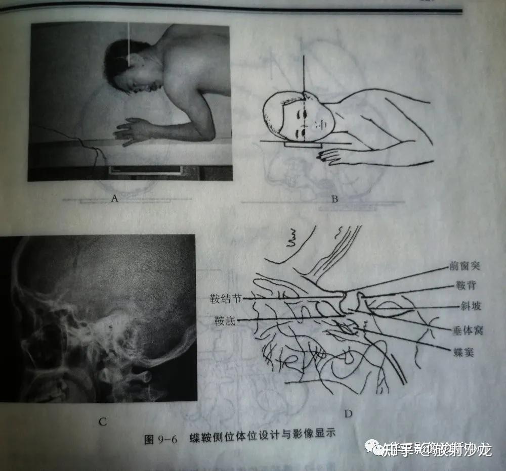 10种头部特殊摄影体位，你会读片吗？ - 知乎