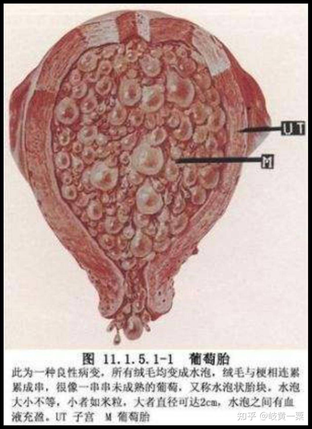 葡萄胎绘图图片