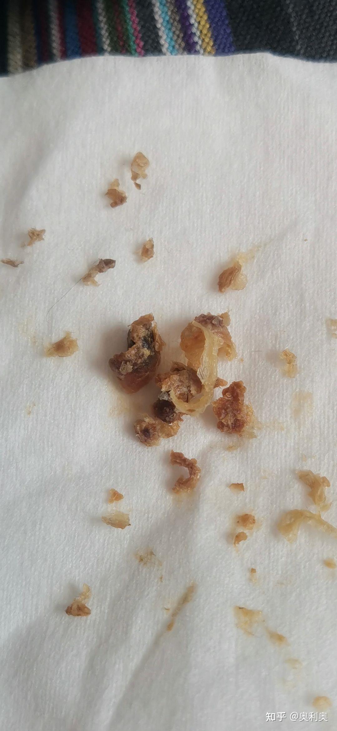 掏出一块超大耳屎,是种什么体验?