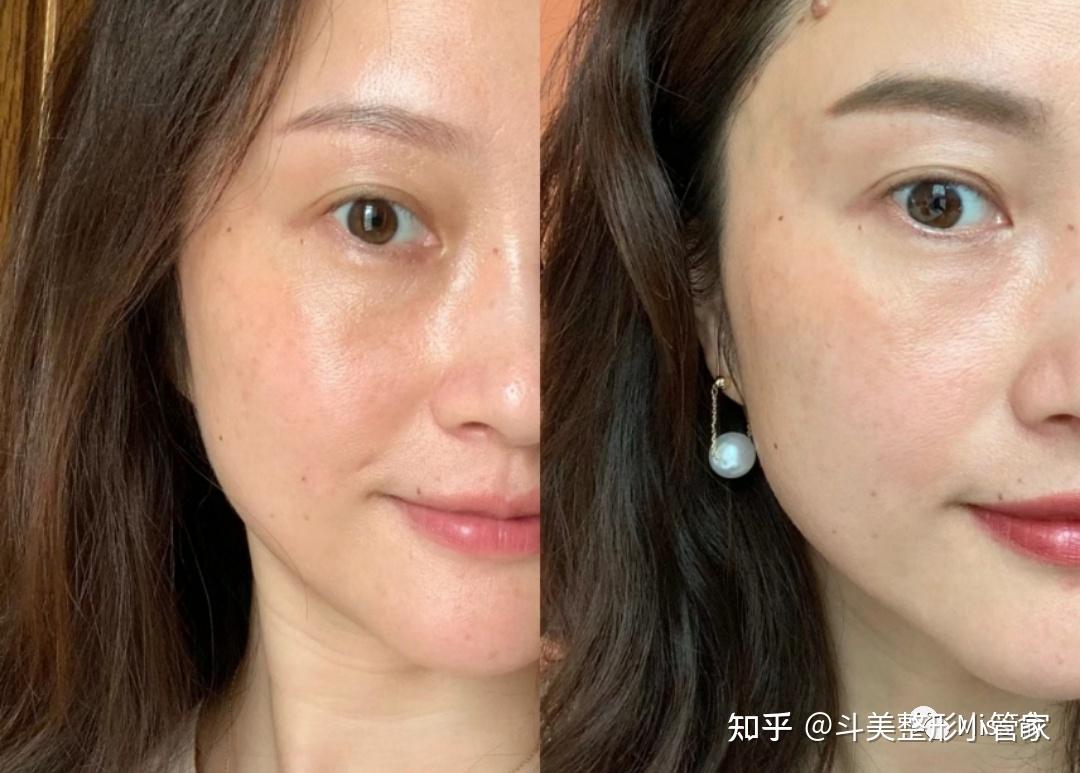 长期打水光针会产生依赖性吗?
