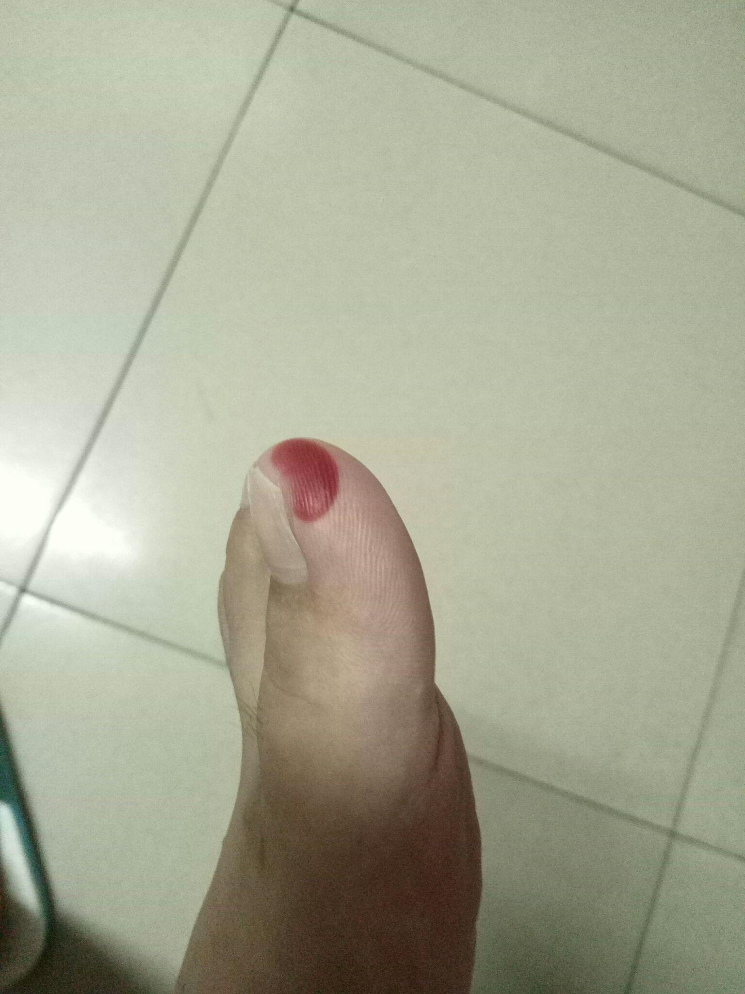 跑步脚趾起血泡怎么办阿?感觉脚要烂了?