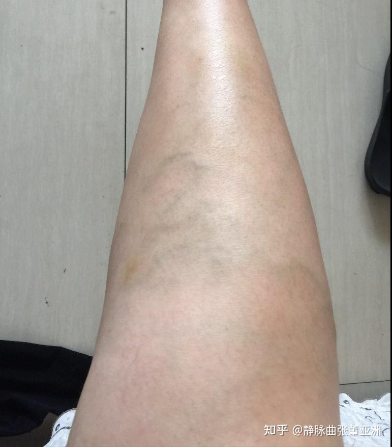 小腿患有静脉曲张能慢跑