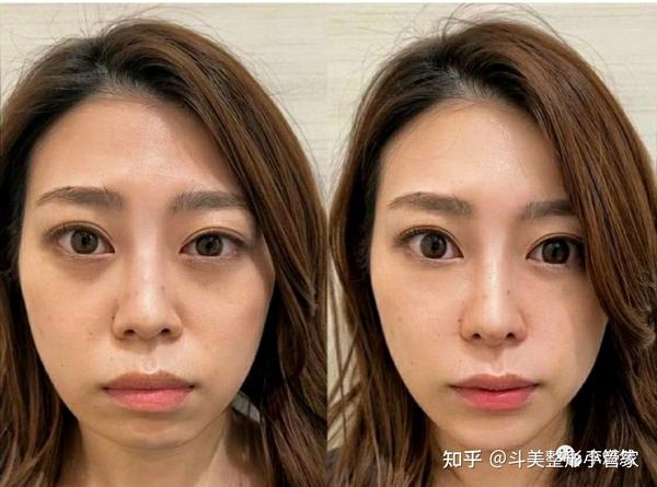 如何改善面部的法令纹有哪些方法值得分享