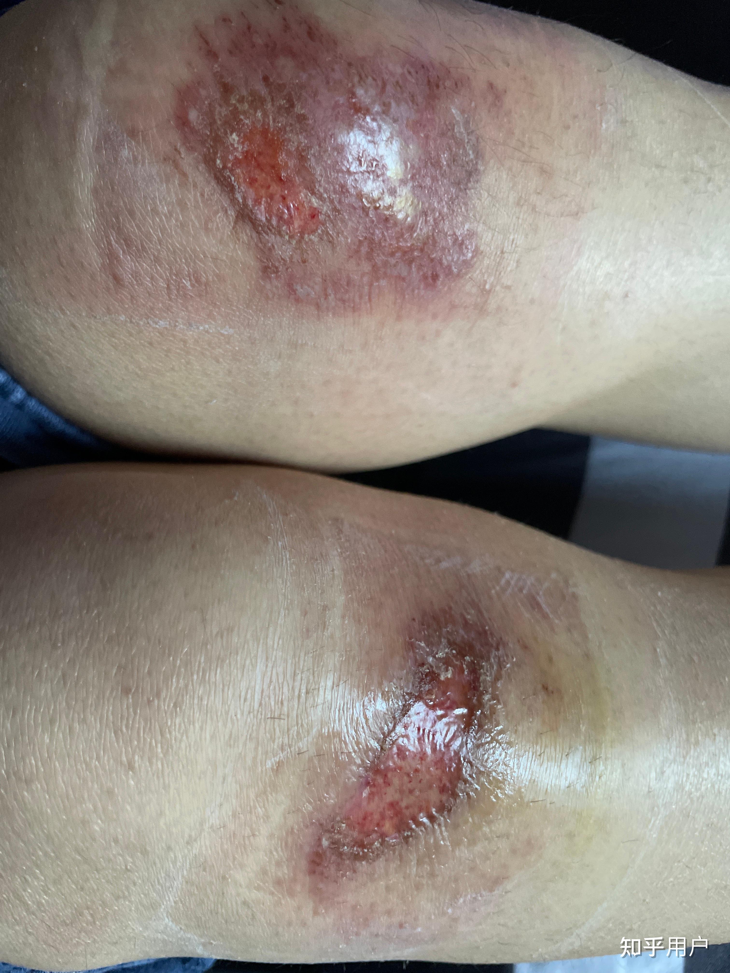 膝盖摔伤,破了一大块皮,流水,抹云南白药好了一点,三天后开始流水了