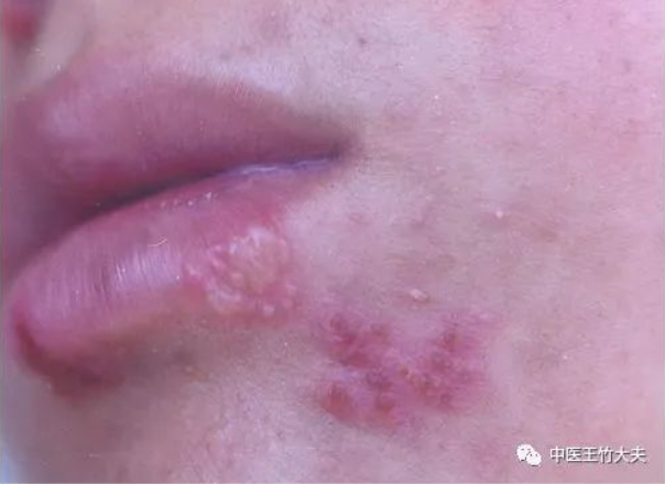 疱疹知识全攻略：了解疱疹的病因、症状和治疗方法 - 知乎