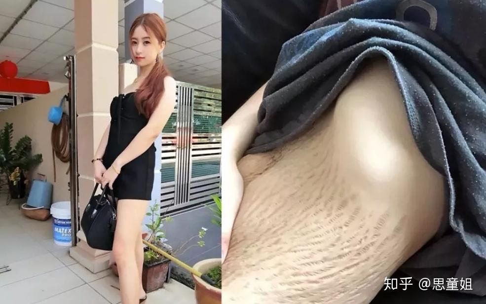 生完宝宝后,腹部的妊娠纹怎么消除? - 知乎