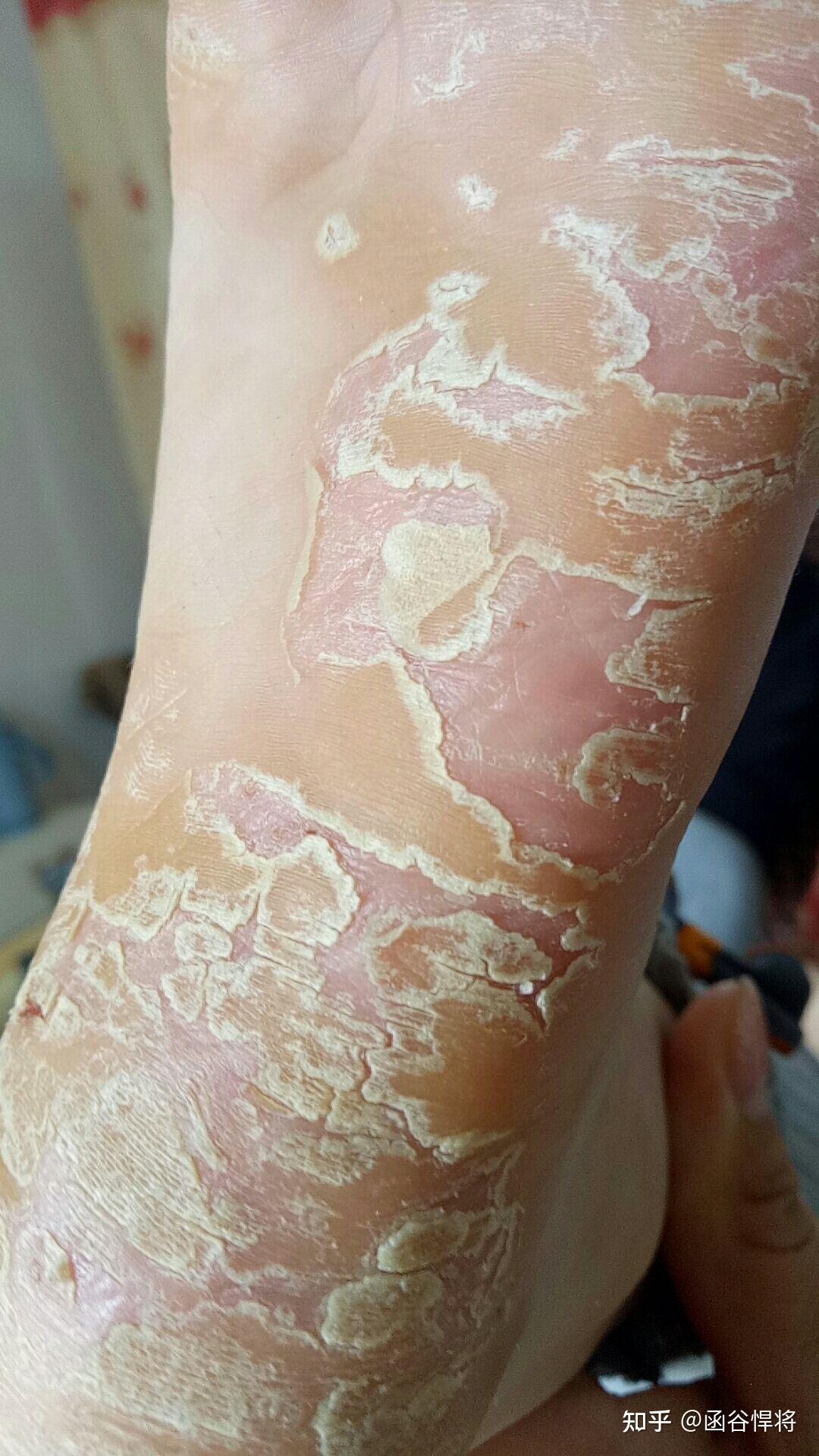脚后跟裂口是什么原因?脚裂裂口子怎么回事? - 知乎