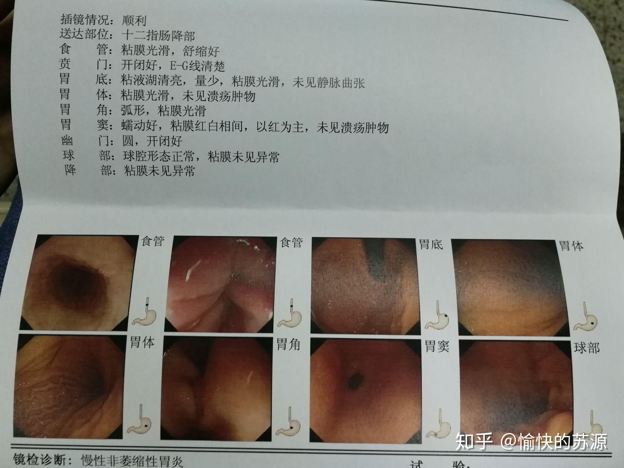 胃出血是一种什么样的体验