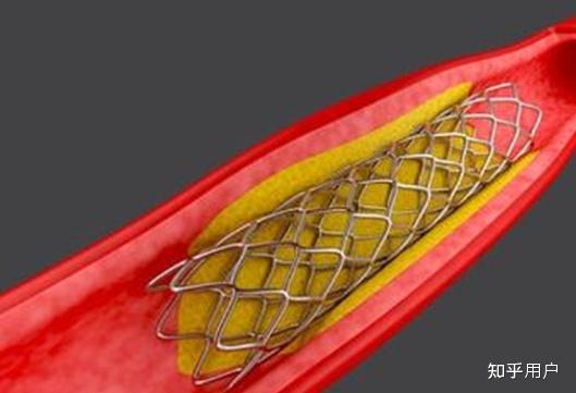 一患者因脑梗去世,医生承认此前未成功植入脑血管支架并隐瞒,两者是否