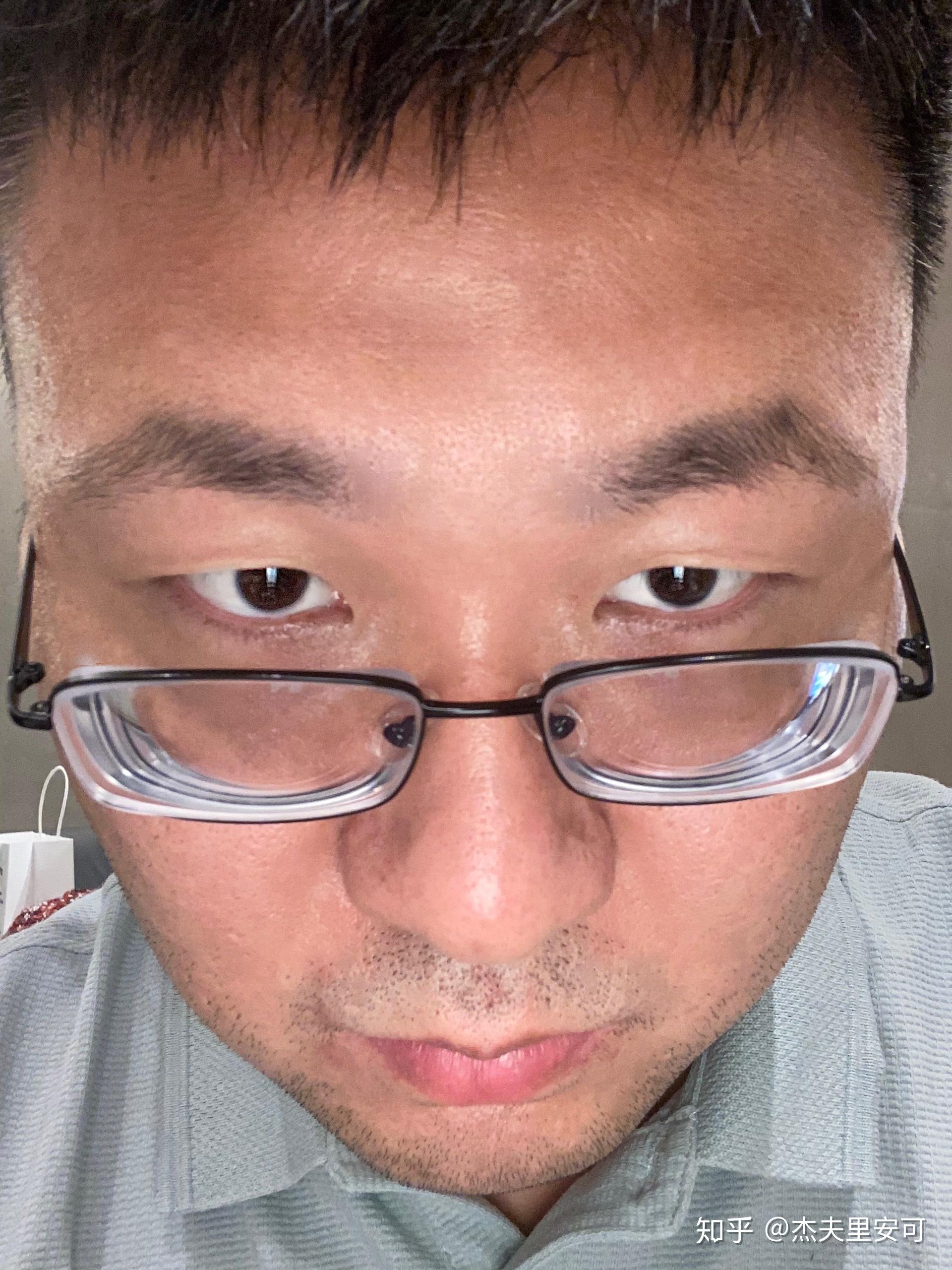高度近视,特别自卑,眼睛也变形了,我该怎么办? - 知乎