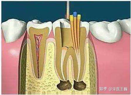 根管治疗后的牙齿为什么还要做打桩?什么是牙齿打桩? - 知乎
