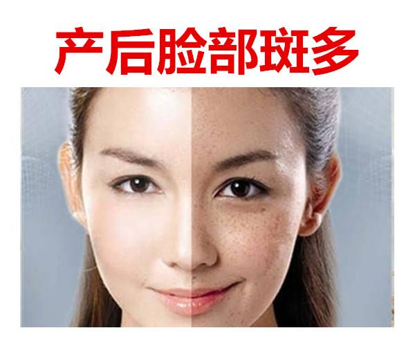 产后面色黄暗、黧黑、斑块多？可能是水斑，老中医教你解决办法 - 知乎