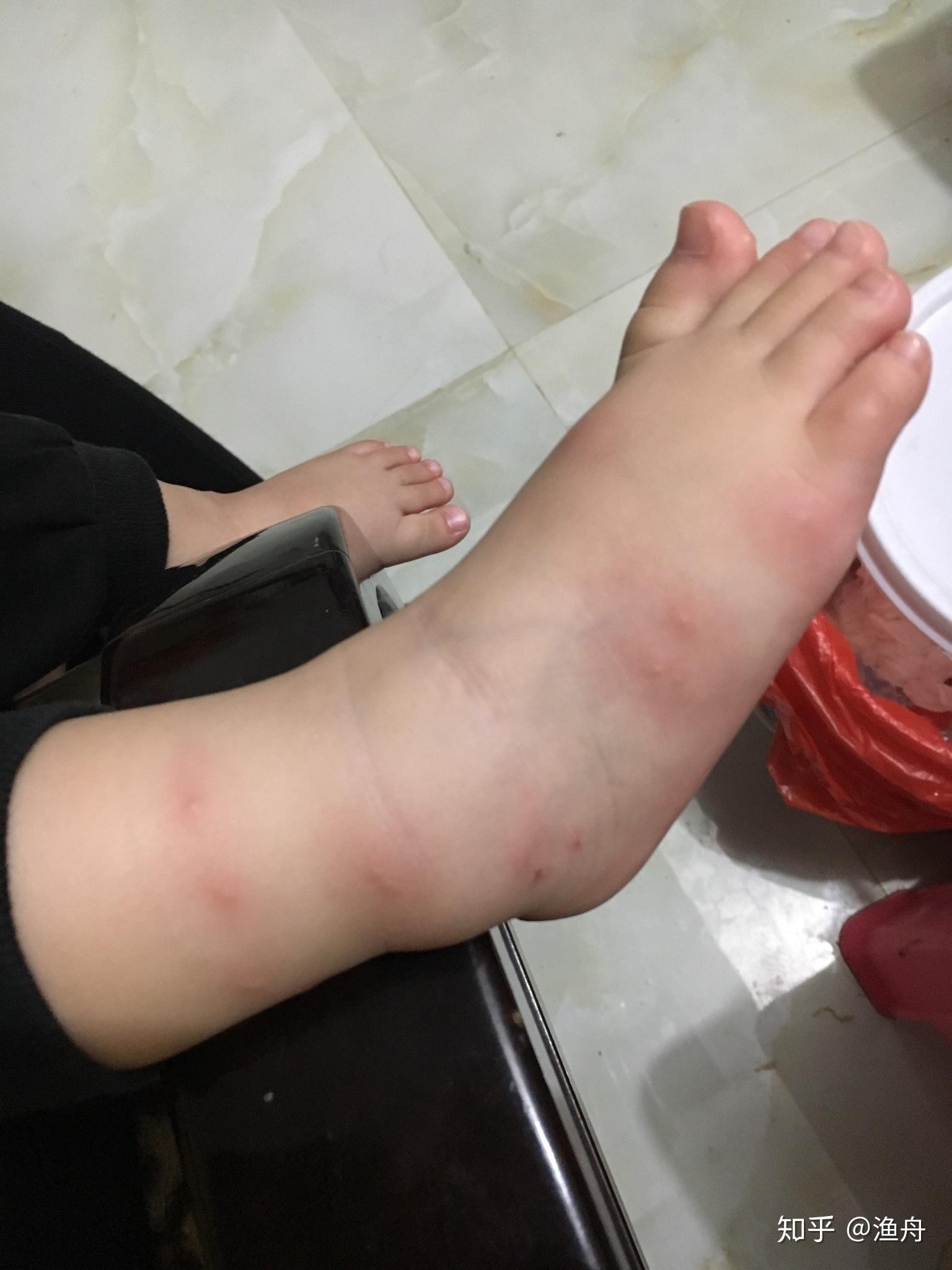 被跳蚤咬的全身都是包是什么样的感受