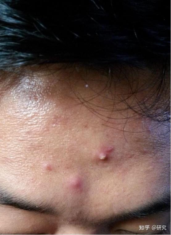 白头痘痘如何避免?