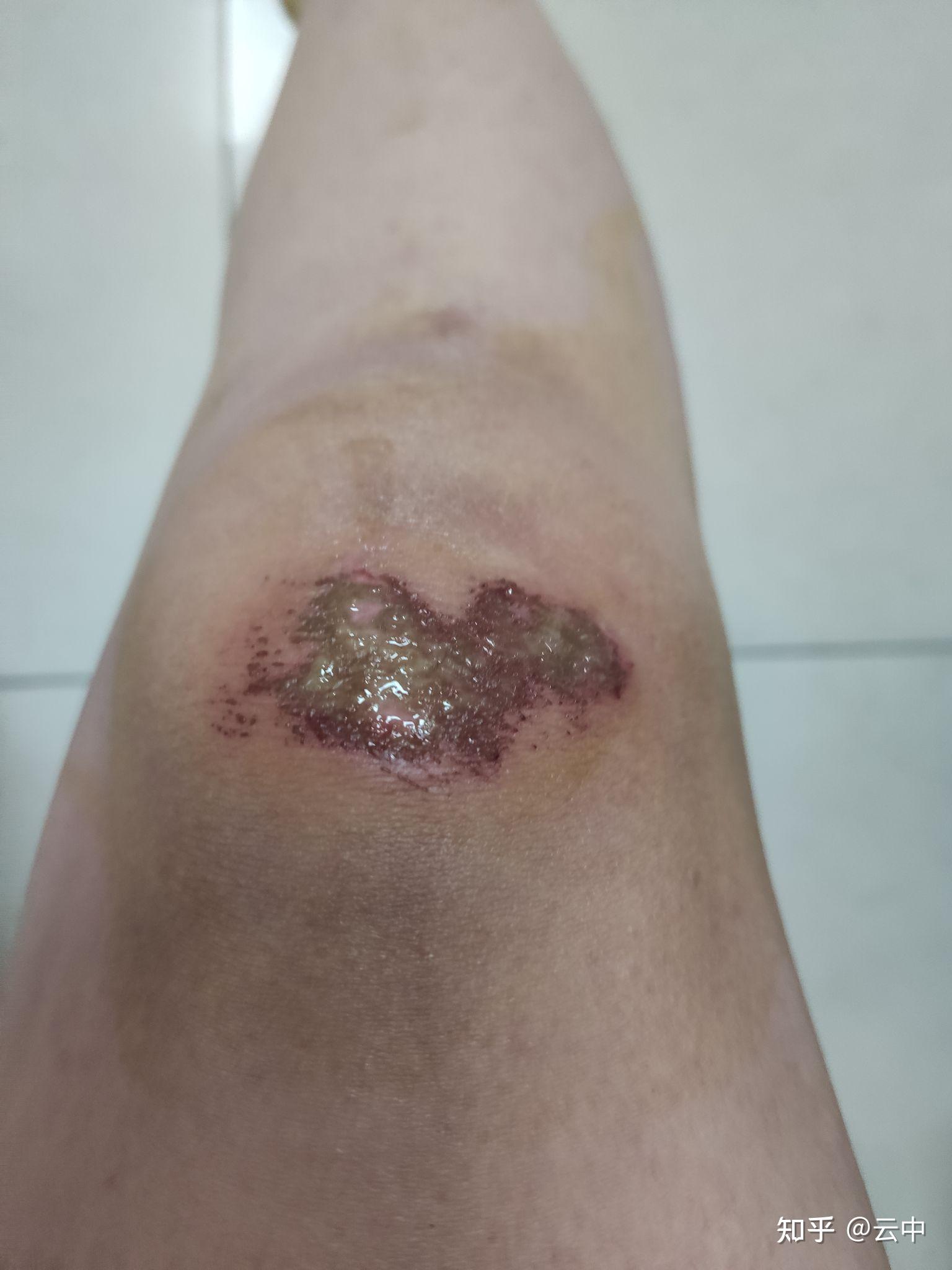 电动车撞人了,造成对方皮外伤.现在找我要2000元. - 知乎