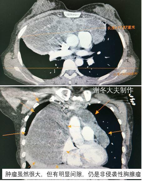 胸腺ct解剖位置图图片