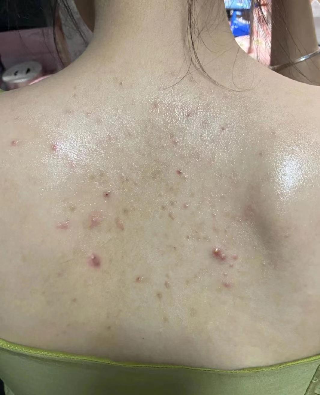 而且还在扩散,医生说是螨虫性皮炎,天天吃药擦