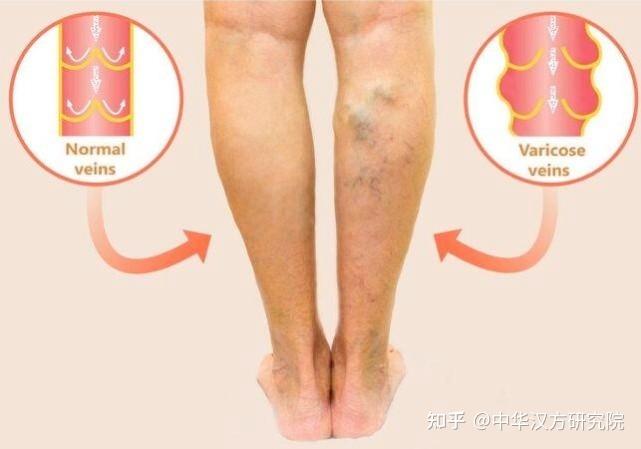 腿部血栓形成的症状是什么? - 知乎