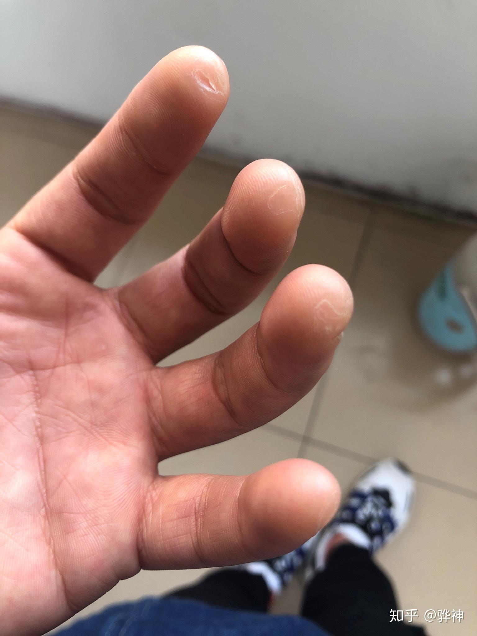 大家弹吉他的手指都是什么样的? - 知乎
