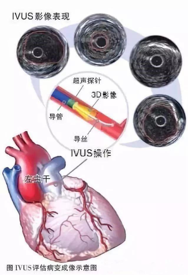 现役飞行员冠心病系列八：血管内超声检查有助于航空风险的判断 - 知乎