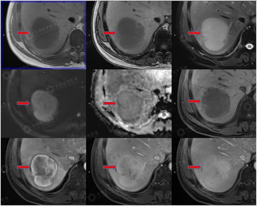 肝脏占位难定性，PET/CT-MR异机融合鉴良恶！ - 知乎