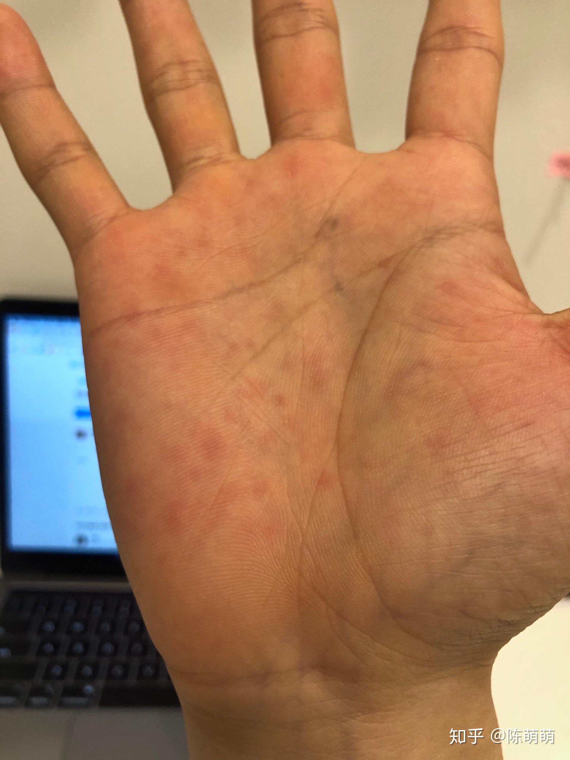 我对蓝色丁腈手套过敏大家有遇见过类似情况吗