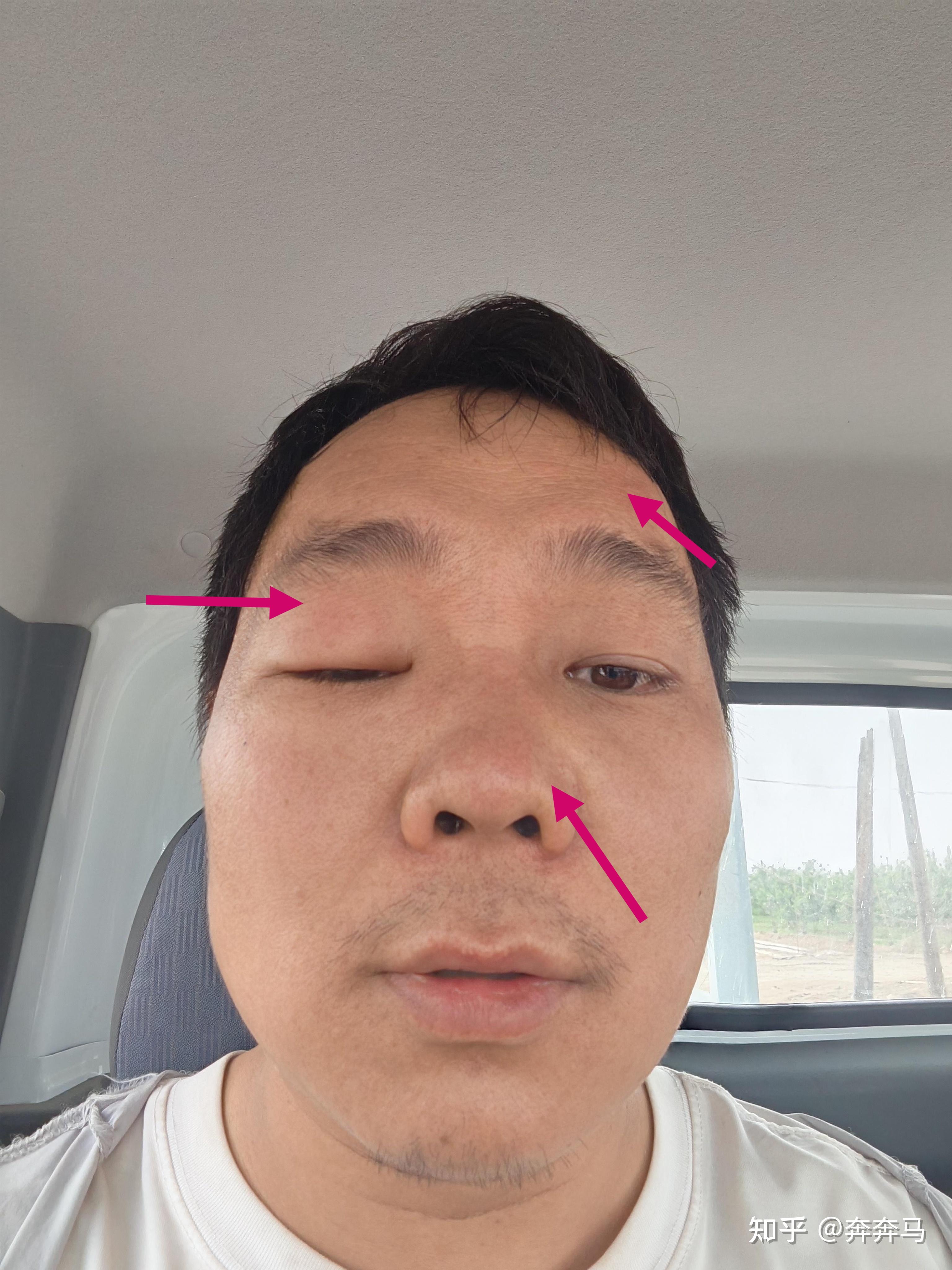 4 岁女童在家中被蜜蜂蛰伤致死,爸爸哭诉距养蜂场只有 1 千米,蜜蜂蛰