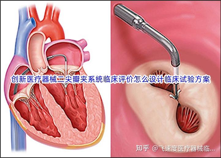 钳夹止血法图解图片