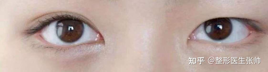 内双与单眼皮割双眼皮有不同吗?一单一双能只做一边吗? - 知乎