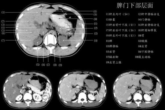 一图教你读懂 腹部CT - 知乎