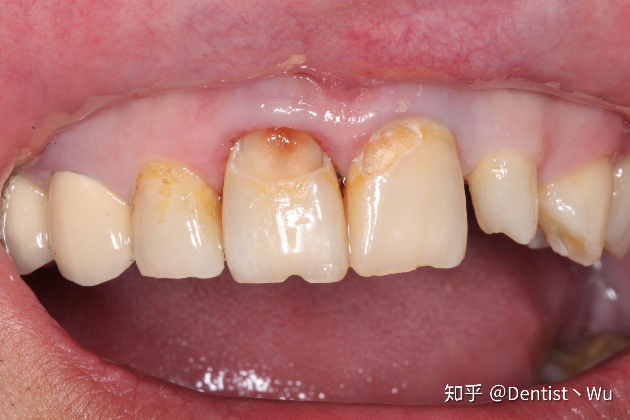 我爱人的牙齿楔状缺损,请问这种缺损程度需要填充修补吗?