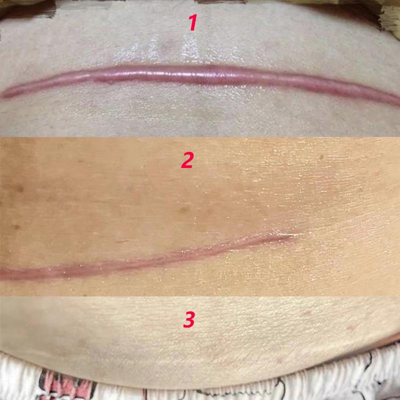 剖产刀口3年!办法尝试了几十种,可依旧很明显 怎么办? - 知乎