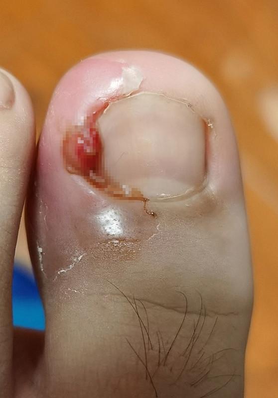 甲沟炎太痛了化脓搞出肉芽在宿舍自己处理