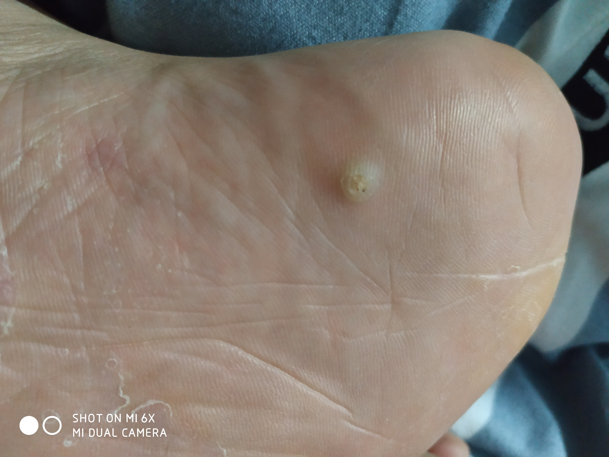 脚上长了鸡眼怎么才能治好呢