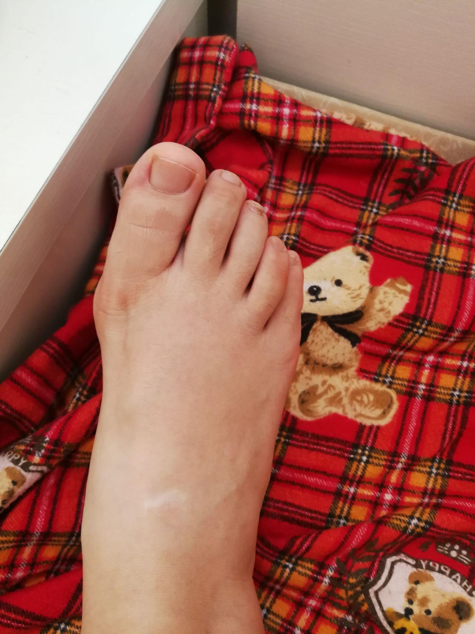 作为一个女生,脚拇指外翻是一种怎样的体验? - 知乎