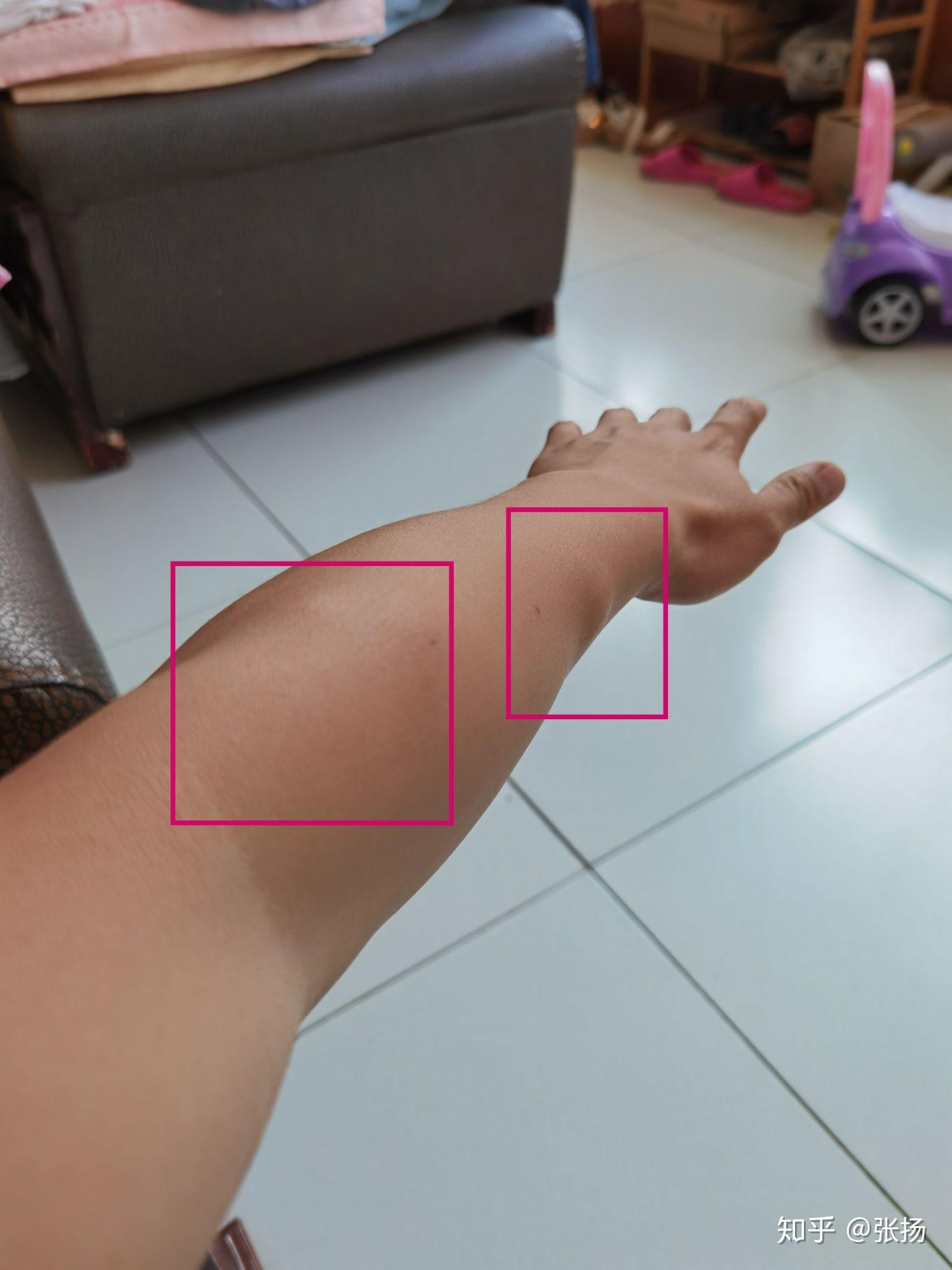 我是一名18岁的男生胳膊和大腿上都长有脂肪瘤请问脂肪瘤能不能治好